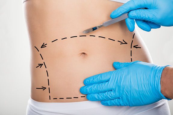 Abdominoplastik Rosenheim